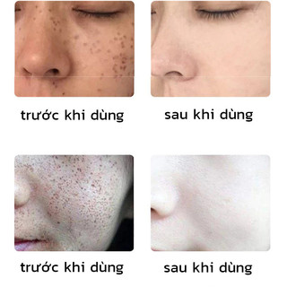 tinh chất cấy trắng da mặt 7 ngày sạch tàn nhang Serum trắng da và xóa tàn nhang 30ml Hiệu quả làm mờ thâm nám tàn nhan