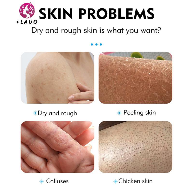 Springevenstar 40% Urea 2% Axit Salicylic Kem Dưỡng Ẩm Chăm Sóc Tay Kem Dưỡng Ẩm Chống Chèo Loại Bỏ Da Chết Chăm Sóc Da Springevenstar