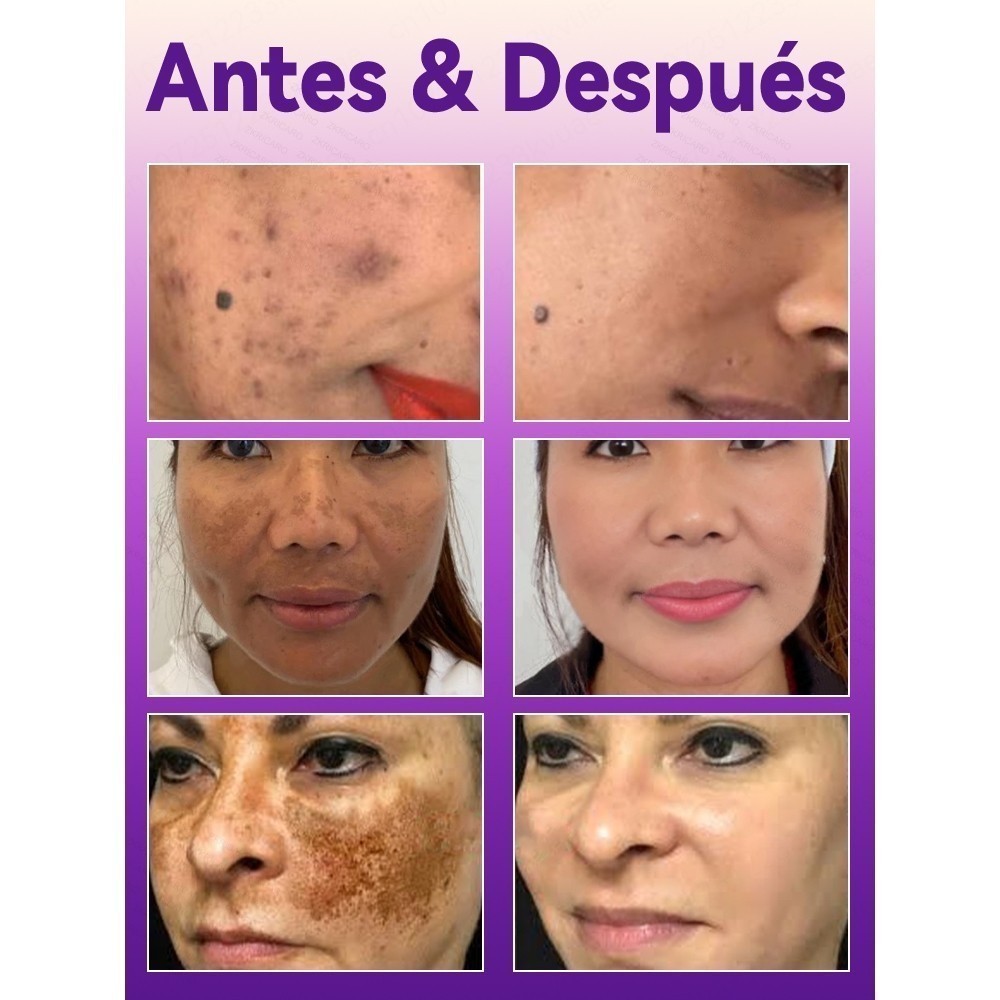 Bút Laser chăm sóc điểm di động Làm sáng da không xâm lấn cho người lớn Sử dụng tại nhà & du lịch để cải thiện điểm