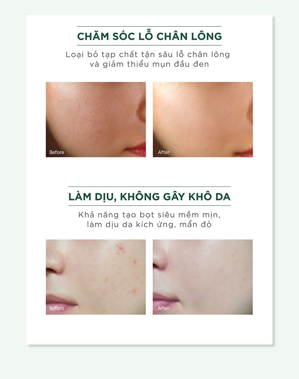 Mô tả Bộ chăm sóc da mụn Caryophy portulaca (sữa rửa mặt 150ml toner 300ml) - 3