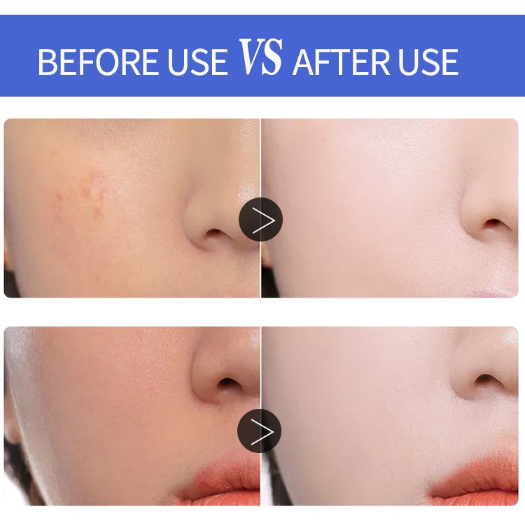 Mô tả Serum niacinamide LIYALAN 30ml chứa Vitamin B3 5% 10% chống mụn chống nhiễm trùng làm trắng da mặt - 4