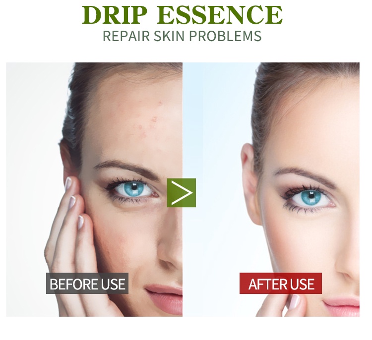Mô tả Serum Vitamin B5 LIYALAN với axit hyaluronic dưỡng ẩm ngừa sưng da hiệu quả 30ml - 2
