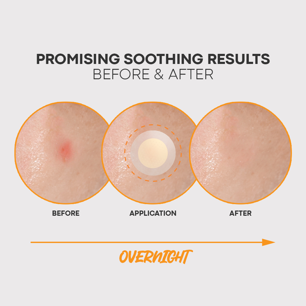 NOLAHOUR Spot Eraser Orange 12 Miếng Dán Làm Mờ Vết Đỏ Sau Mụn, Sáng Da Đều Màu