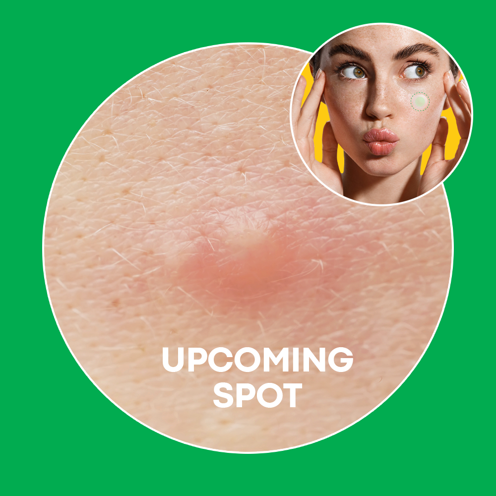 NOLAHOUR Spot Eraser Green + Blue Miếng Dán Làm Dịu Mụn Mới Nổi, Che Phủ & Bảo Vệ Vết Mụn Sau Nặn