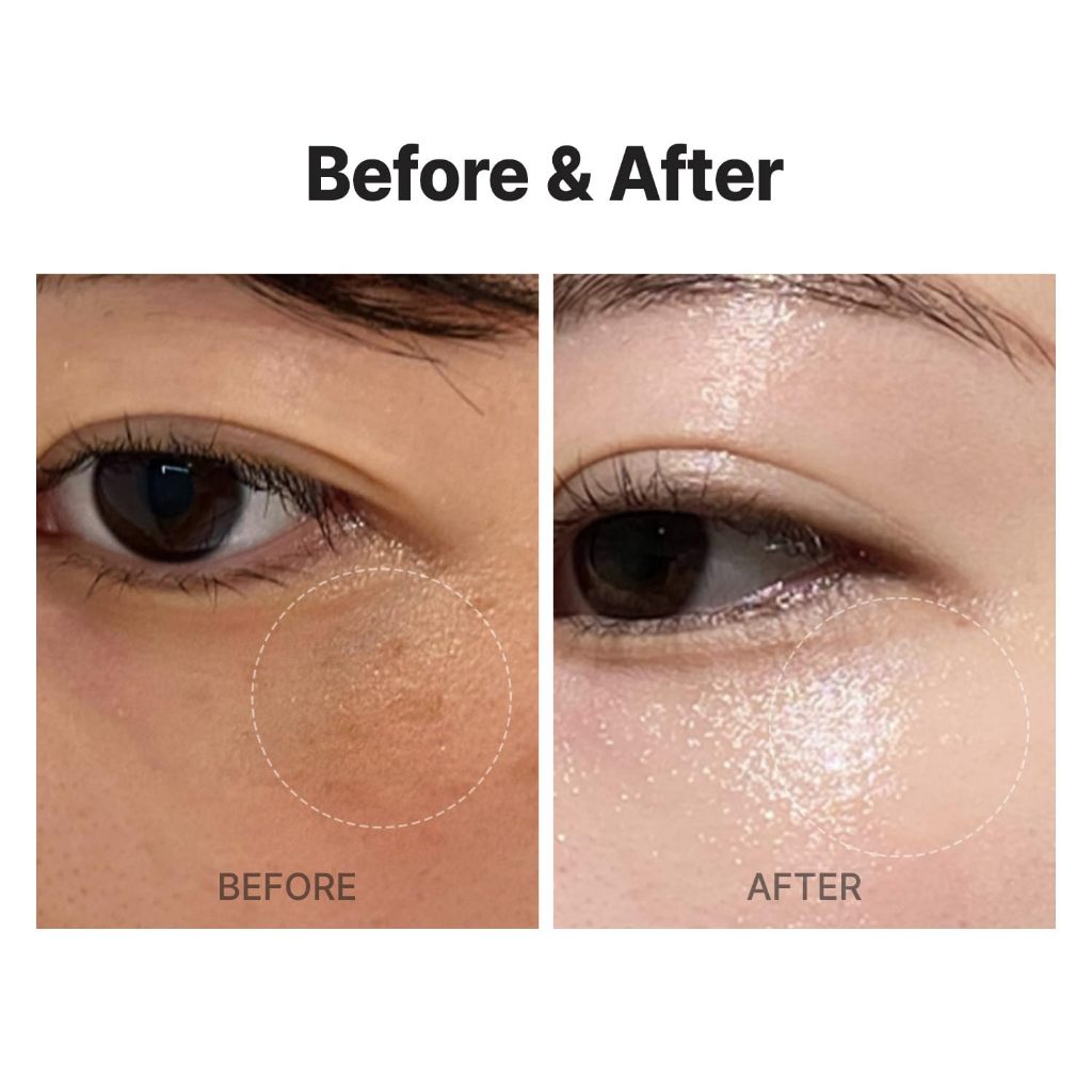 [Meditherapy] Vita Real Shot Clear Patch (6 miếng dán) - Miếng dán vết thâm, Chăm sóc mụn trứng cá và vết thâm, Miếng dán thủy ngân, Vitamin C nguyên chất để làm sáng da