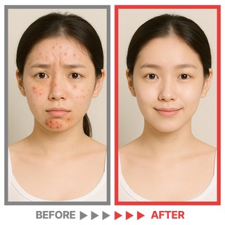 Giảm Mụn Viêm Cấp Tốc Kem Chấm Mụn Sulfur 20% Lưu Huỳnh Kháng Khuẩn Cho Da Dầu Nhạy Cảm ENCA