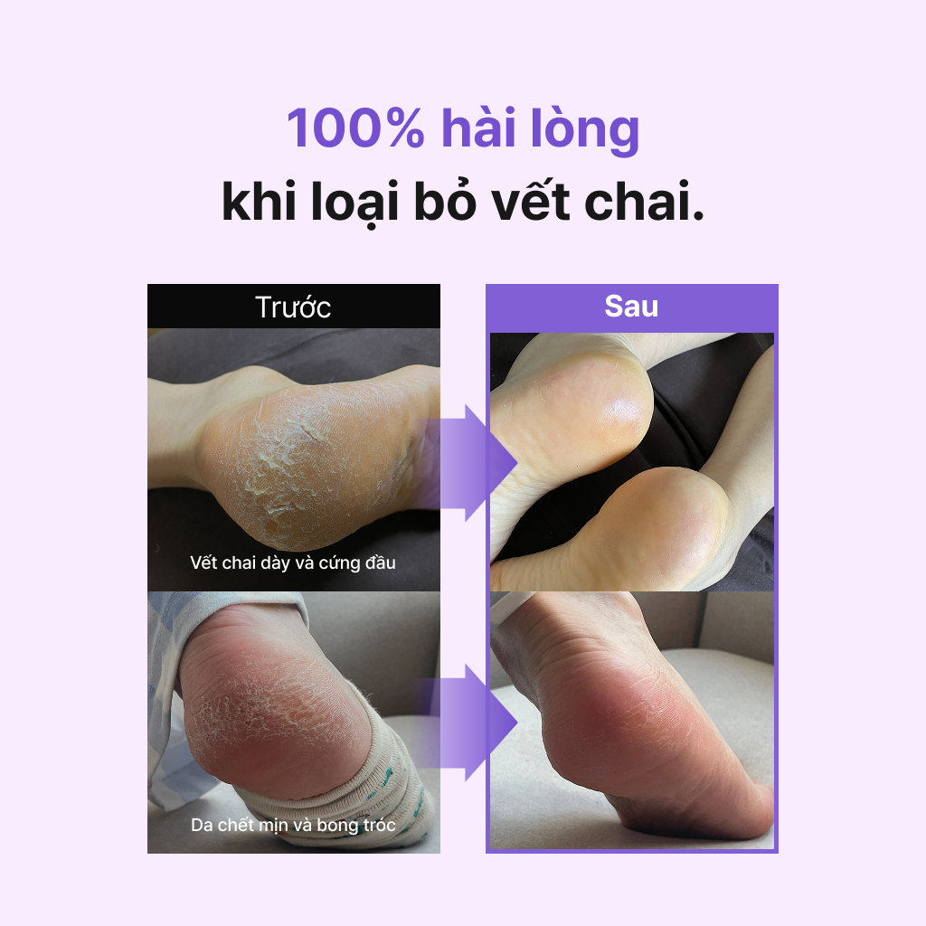 [BEST] Bộ dụng cụ tẩy vết chai 1 phút BAREN cho bàn chân: Dụng cụ chà gót & Xịt peel chân [Tẩy da chết, Dụng cụ làm móng chân, Tẩy tế bào chết]