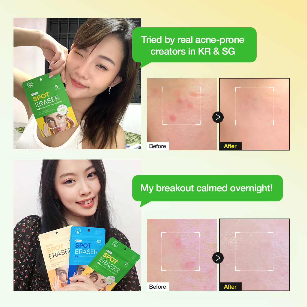 NOLAHOUR Spot Eraser Green Miếng Dán Làm Dịu Mụn Mới Nổi, Giảm Đỏ Trước Khi Lên Mủ