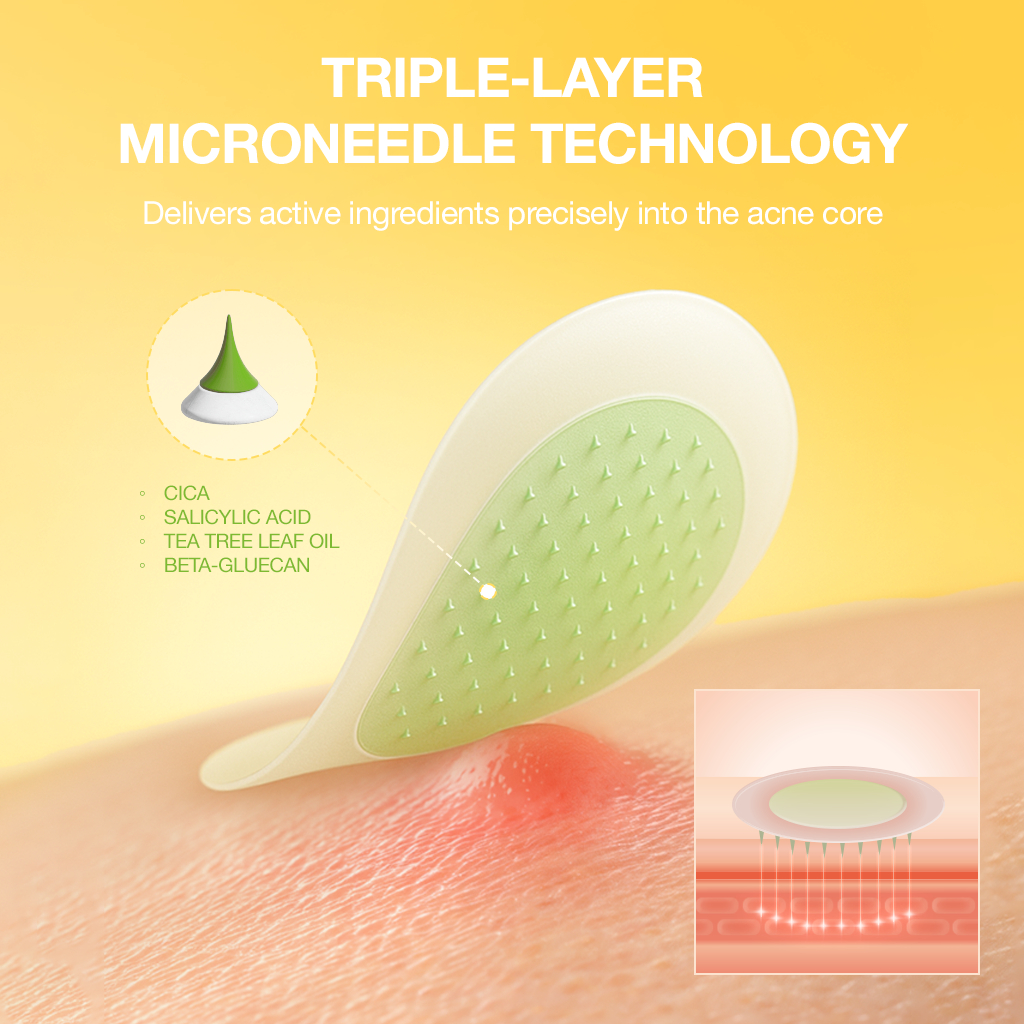 NOLAHOUR Spot Eraser Green Miếng Dán Làm Dịu Mụn Mới Nổi, Giảm Đỏ Trước Khi Lên Mủ