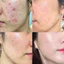 Serum tái tạo nhân sâm, Ginseng Herbal Skin Peel cao cấp Giảm Mụn, Mờ Thâm, Phục Hồi da,