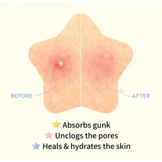 [OOTD] Miếng dán vết thâm Hydrocoloid Care Star Spot 80Patches