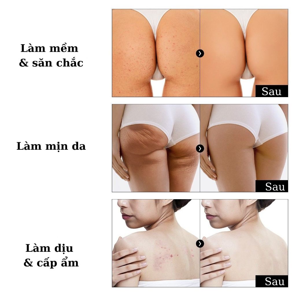 Kem Hỗ trợ giảm mụn mông & lưng Hàn Quốc -100ml - BnD Butt Cream 100g