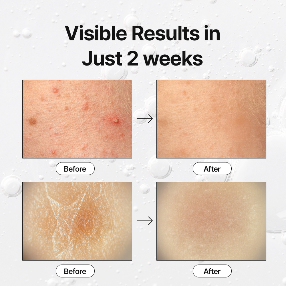 Clinto Pico Exosome Ampoule Pore & Acne (Rosemary Exosome, Spicule, AHA, BHA, PHA) (30ml * 1ea)