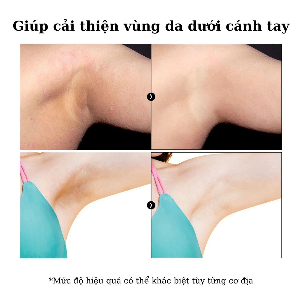 Kem hỗ trợ giảm thâm nách Hàn Quốc (BnD Underarm Cream) - 100g
