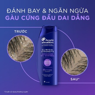 Dầu Gội HEAD & SHOULDERS Clinical Strength 4X Sức Mạnh Dành Cho Da Đầu Có Gàu Dai 400ml - Bebeau