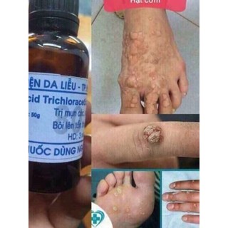 Lọ chấm tẩy mụn cơm, mụn cóc, mụn thịt, nốt ruồi, vết chai sần