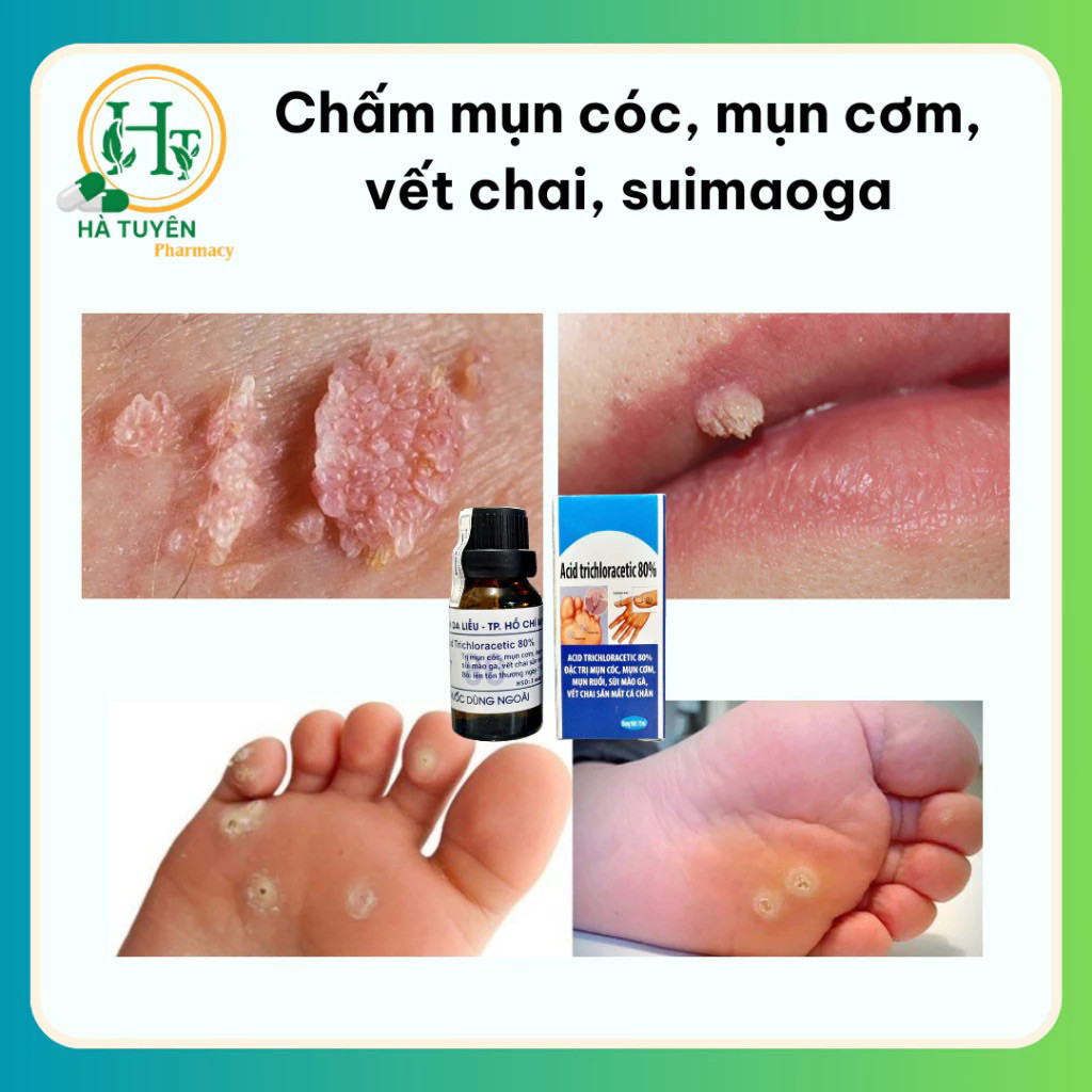 Chấm mụn cóc, mụn cơm, mụn thịt, suimaoga