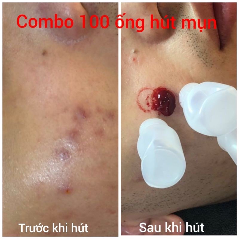 Combo 100 ống nhựa hút mụn, lọ nhựa hút mụn, hút máu bầm