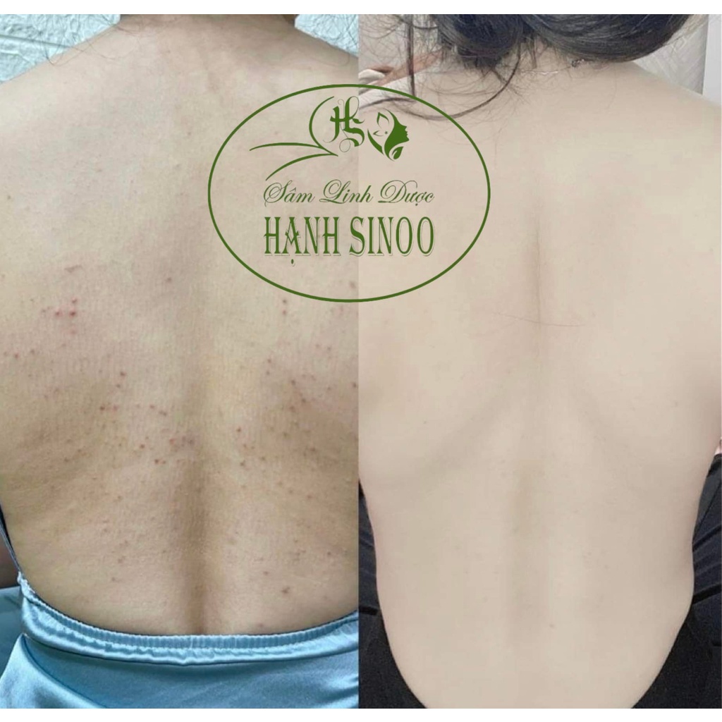 Tái tạo da Đông y Cốt sâm Hạnh Sinoo - hỗ trợ da hiệu quả, phù hợp với da sẹo rỗ,handmade by Hạnh