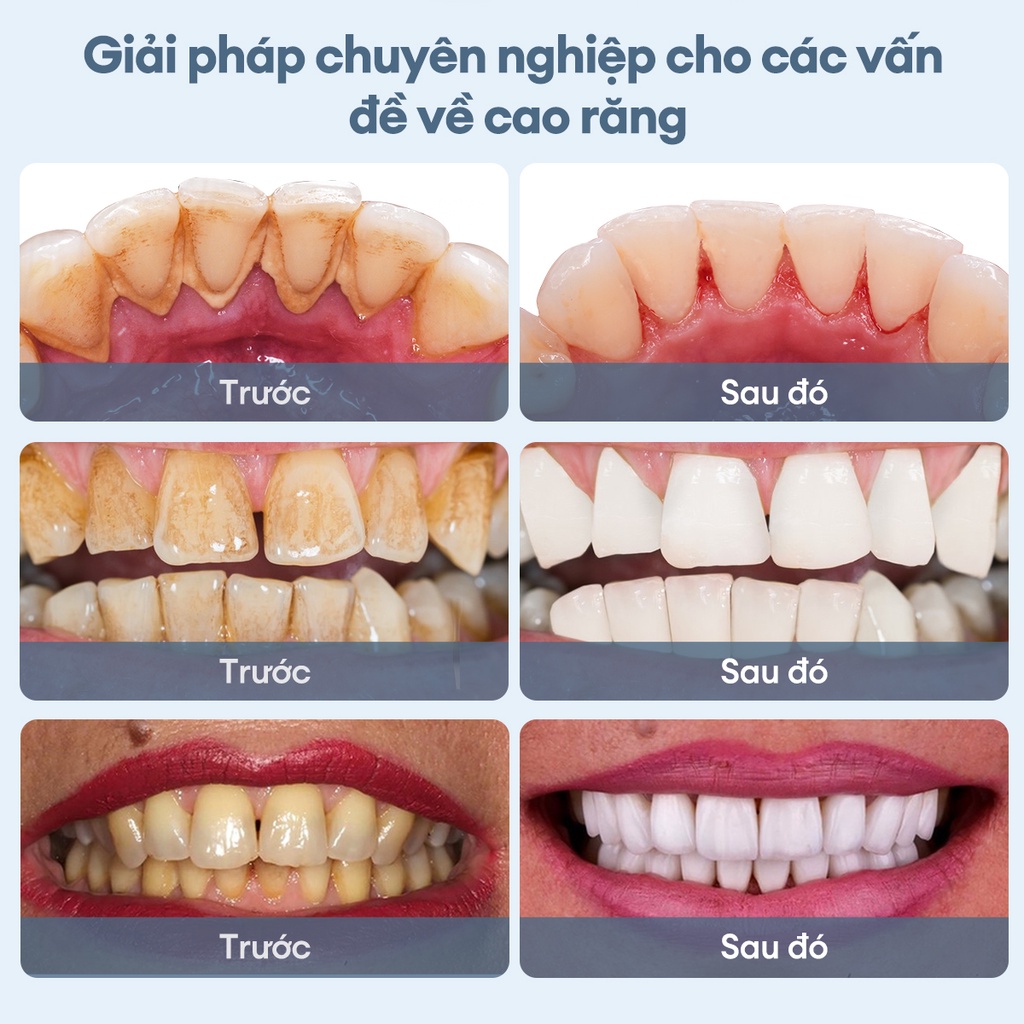 Ảnh Máy lấy cao răng CKEYIN KQ158W loại bỏ vi khuẩn/vết ố/làm sạch răng nướu kèm 2 đầu làm sạch thay thế tại nhà 4