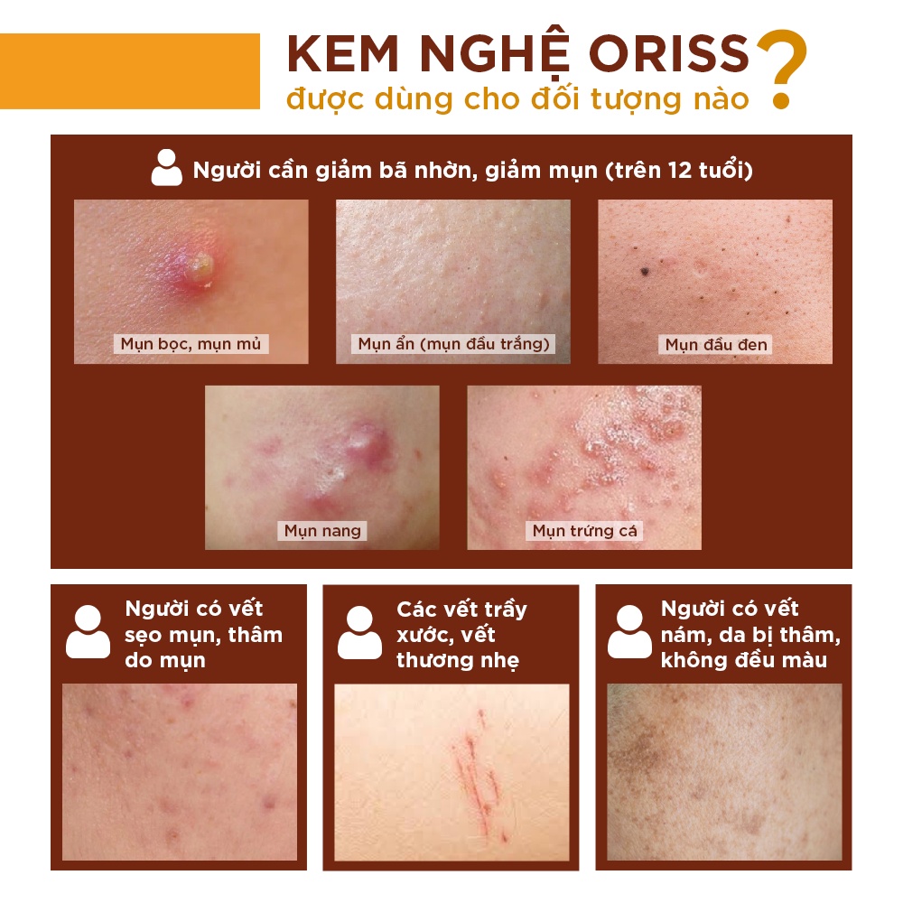 Kem nghệ Oriss ngừa mụn giảm thâm mờ sẹo dạng gel không màu không gây vàng da Tuýp 20gr