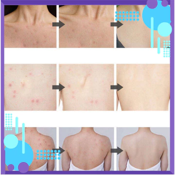 {chính hãng} Sữa tắm chống ve Sữa tắm loại bỏ mụn sữa tắm trắng da 300ml Làm sạch sâu bụi bẩn dưới da Giảm mụn lưng