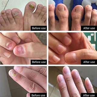 Nấm móng tay chân dạng xịt iBeaLee 10ml dưỡng cứng móng hết sạch nấm bọng móng TP11