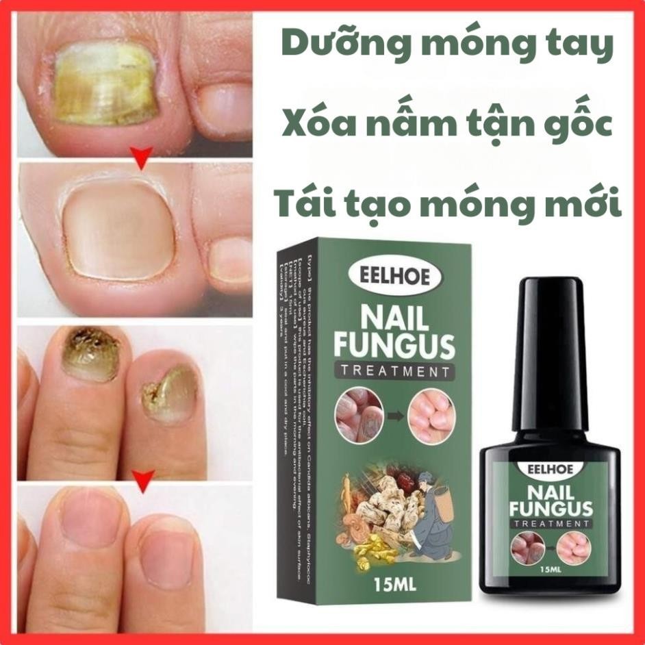 Serum nấm móng tay chân dưỡng cứng móng EELHOE 15ml hết sạch nấm bọng móng hư khoé nước H10