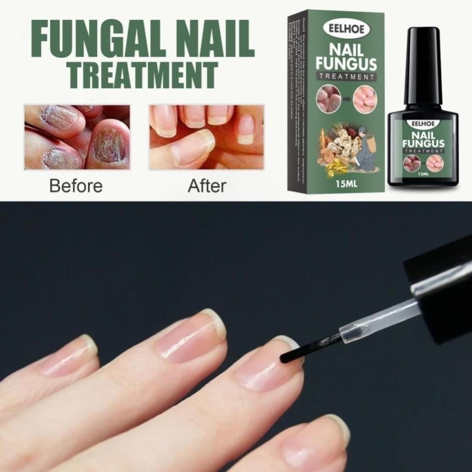 Serum nấm móng tay chân dưỡng cứng móng EELHOE 15ml hết sạch nấm bọng móng hư khoé nước H10