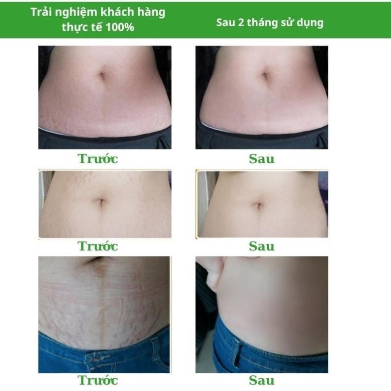 Kem bôi rạn da giảm sẹo sau sinh SNMLPM Kem dạn da sau sinh làm trắng săn chắc mịn màng H04