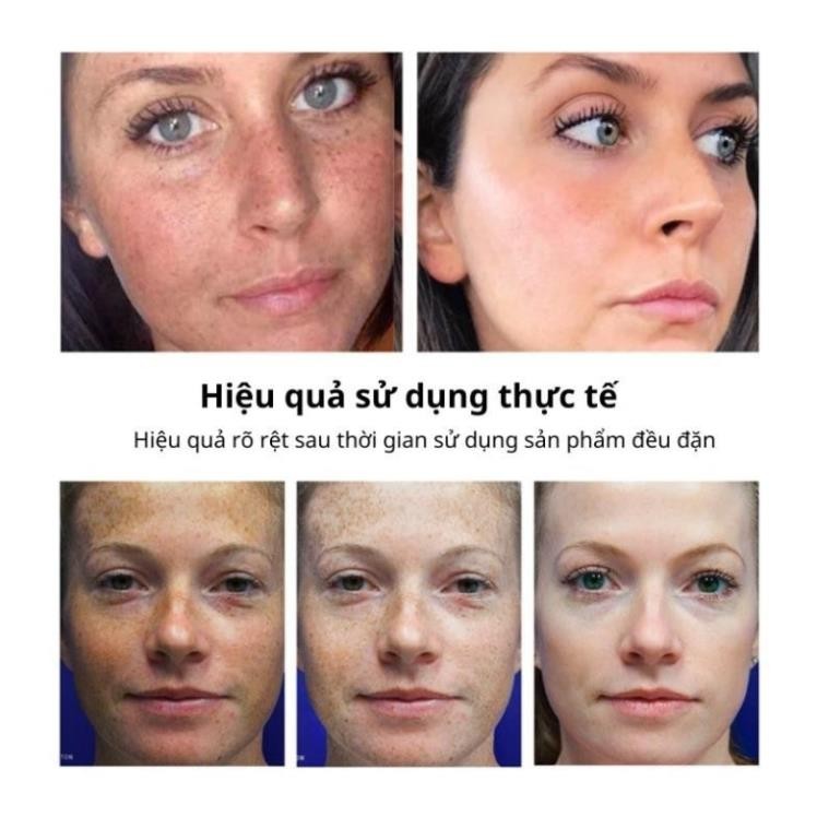 Kem bôi nám tàn nhang FRECKLE CREAM xóa mờ vết thâm nám tàn nhang đồi mồi chống lão hoá H03
