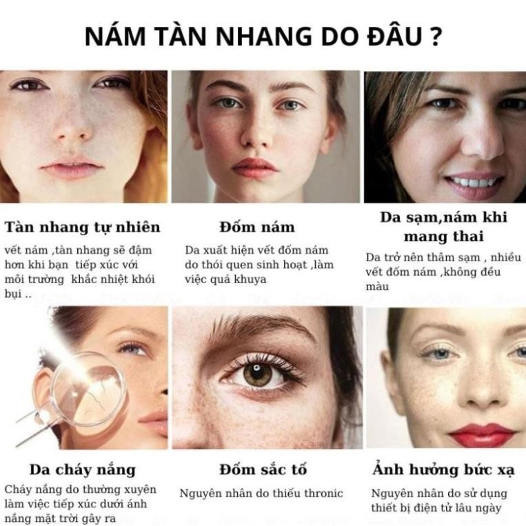 Kem bôi nám tàn nhang FRECKLE CREAM xóa mờ vết thâm nám tàn nhang đồi mồi chống lão hoá H03