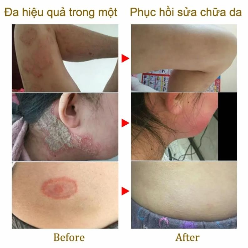 Kem viêm da cơ địa Nội địa Trung 30g hết ngứa tái tạo da Kem bôi nứt nẻ gót chân an toàn H13
