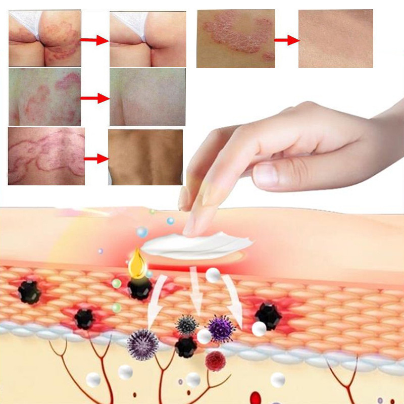 Kem viêm da cơ địa Nội địa Trung 30g hết ngứa tái tạo da Kem bôi nứt nẻ gót chân an toàn H13