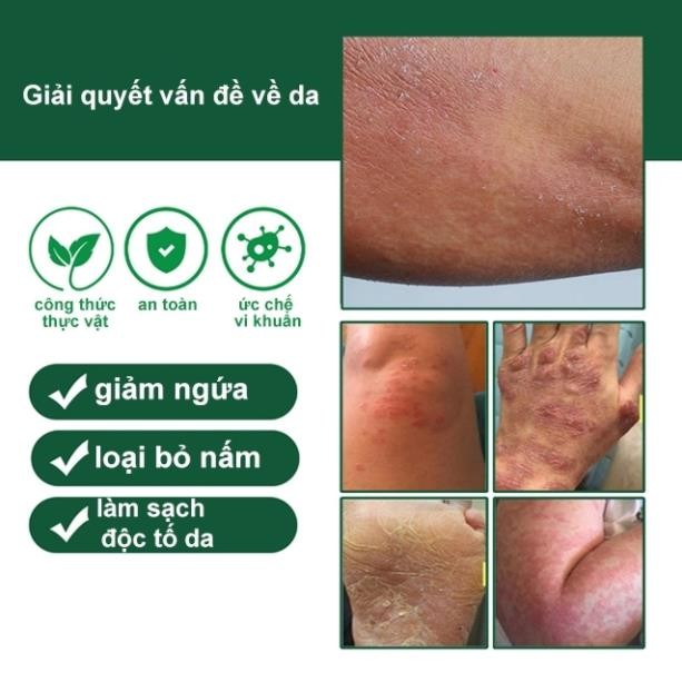 Kem viêm da cơ địa Nội địa Trung 30g hết ngứa tái tạo da Kem bôi nứt nẻ gót chân an toàn H13