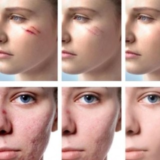 Kem mờ sẹo Vibrant 20g làm mờ sẹo lâu năm loại bỏ sẹo mụn sẹo lồi lõm rạn da sau sinh