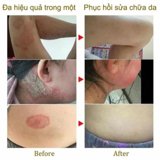 Kem viêm da cơ địa Nội địa Trung 30g tái tạo da hết ngứa Kem bôi nấm ngứa da nứt nẻ gót chân