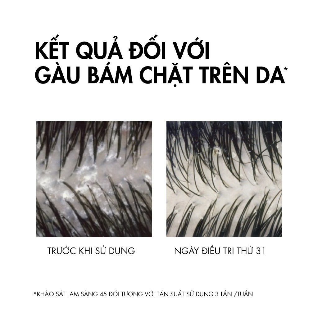 Ảnh Dầu gội sạch gàu cho da đầu dầu, ngứa Vichy Dercos Anti Dandruff 200ml 2