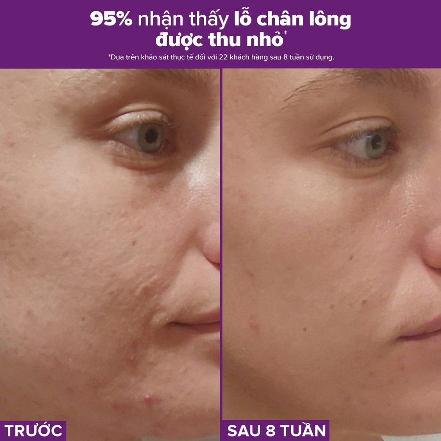 Ảnh Tinh chất se khít lỗ chân lông tối ưu Paulas Choice Niacinamide 20% Treatment 2ml 78032 2