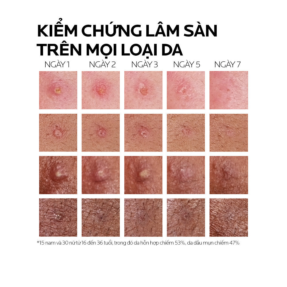 Ảnh Kem dưỡng giảm mụn nhanh 8 giờ La Roche-Posay Effaclar Duo+ M 7.5ml 3