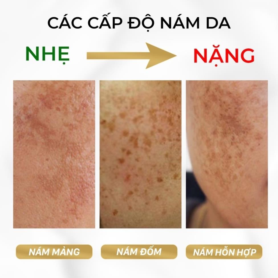Kem Nám Tàn Nhang, Serum YANHEE Weilaiya Cao Cấp Mờ Nám Tàn Nhang Đồi Mồi Dưỡng Ẩm Da, Phục Hồi Chống Lão Hóa Da