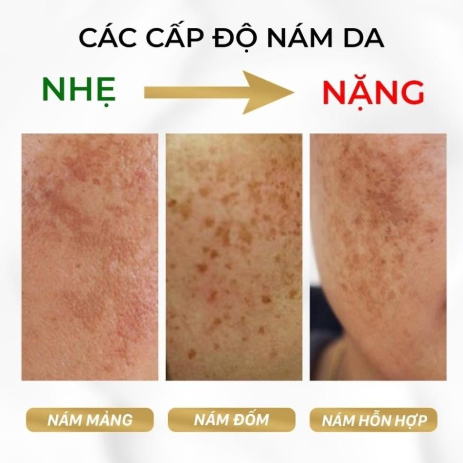 Kem Nám Tàn Nhang, Serum nám YANHEE Weilaiya Cao Cấp Mờ Nám Tàn Nhang Đồi Mồi Dưỡng Ẩm Da, Phục Hồi Chống Lão Hóa Da