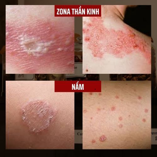 KEM BÔI DA LIỄU ĐÔNG Y - SỦI MÀO GÀ, GIANG MAI, LẬU, HERPES, THỦY ĐẬU, VIÊM RĂNG LỢI, ZONA - HŨ 15g