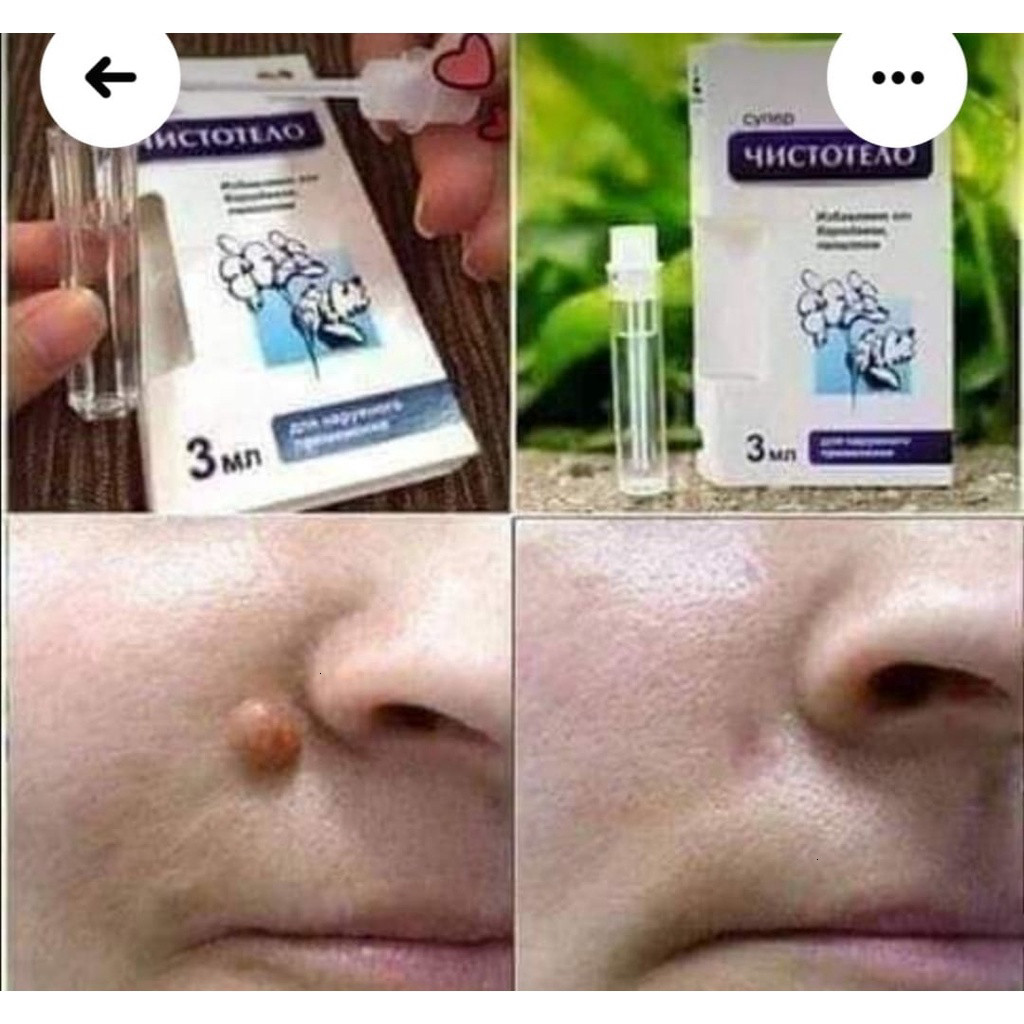 [Chính Hãng] Tẩy Nốt Ruồi, Mụn Thịt, Mụn Cơm, Mụn Cóc....Nga - 1 Lọ