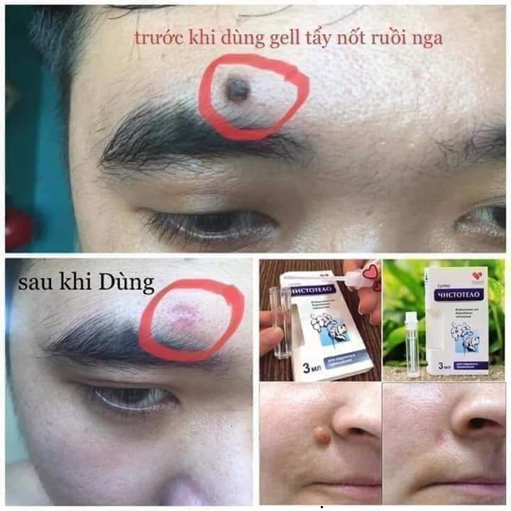 [Chính Hãng] Tẩy Nốt Ruồi, Mụn Thịt, Mụn Cơm, Mụn Cóc....Nga - 1 Lọ