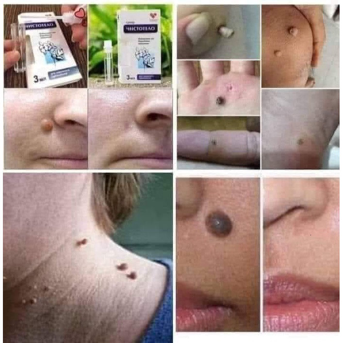 [Chính Hãng] Tẩy Nốt Ruồi, Mụn Thịt, Mụn Cơm, Mụn Cóc....Nga - 1 Lọ