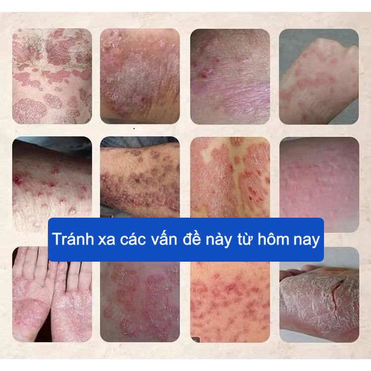 [combo 2 tuýp TĂNG 1] kemXà Sàng Tử, để viêm da dị ứng, chống ngứa, với Nấm Ốc Sên và viêm da dị ứng nấm ngoài