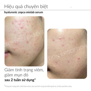 [ XẢ XÓT CTY ] Serum kẽm Ekseption Hyaluronic ZnPCA, HA + 1% ZnPCA giảm mụn, kiềm dầu 75ml FULLBOX VỎ XẤU