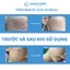Gel xóa Sẹo Lồi / Phì Đại REJUVASKIN Scar Rejuvasil 30ml