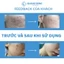 Miếng Dán Hỗ Trợ Xóa Mờ Sẹo Lồi / Phì Đại REJUVASKIN Scar FX Breast Piece